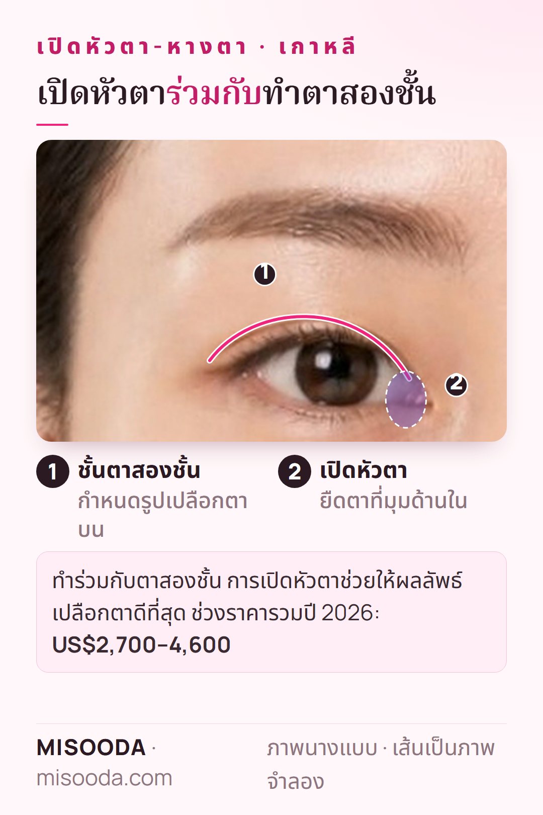 เปิดหัวตาร่วมกับทำตาสองชั้นบนตาข้างหนึ่ง: เส้นชั้นตาพร้อมเปิดมุมตาด้านใน ช่วงราคารวมปี 2026 US$2,700–4,600 ในเกาหลี