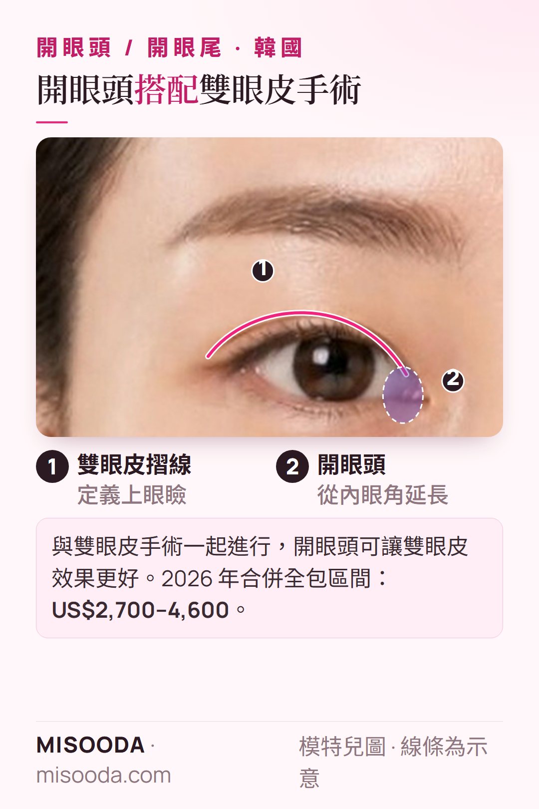 韓國 開眼頭搭配雙眼皮手術單眼示意:雙眼皮摺線加上內眼角打開;2026 年合併區間 US$2,700–4,600