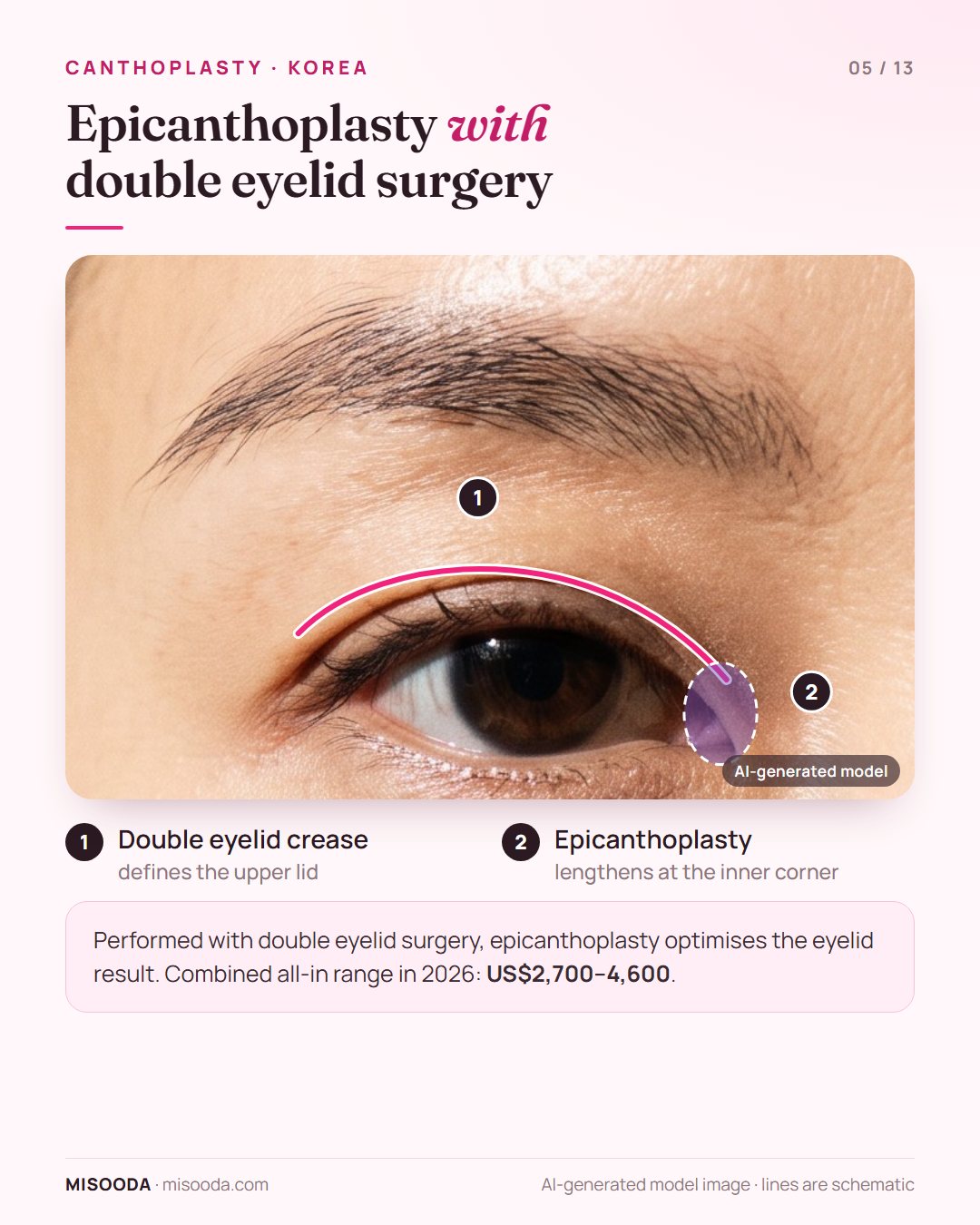 Epicanthoplasty combined with double eyelid surgery on one eye: crease line plus inner corner opening; combined 2026 range US$2,700–4,600 in Korea