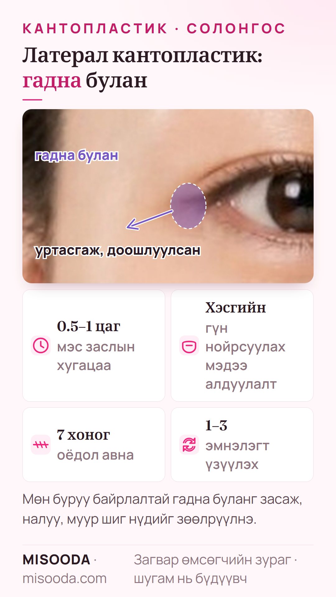 Солонгост хажуугийн кантопластик: налуу, муур шиг нүдийг зөөлрүүлэхийн тулд нүдний гадна буланг уртасгаж, доошлуулна; 0.5–1 цаг, оёдлыг 7 хоногийн дараа авна