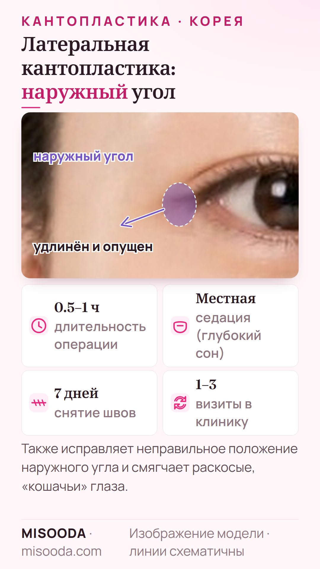 Латеральная кантопластика в Корее: наружный угол глаза удлиняют и опускают, смягчая раскосые «кошачьи» глаза; 0.5–1 час, швы снимают на 7 день