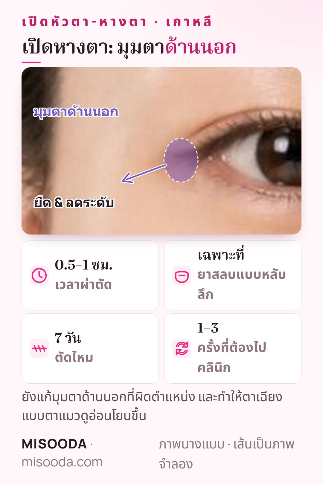 เปิดหางตาในเกาหลี: ยืดและลดระดับมุมตาด้านนอกเพื่อให้ตาเฉียงแบบตาแมวดูอ่อนโยนขึ้น ใช้เวลา 0.5–1 ชั่วโมง ตัดไหมที่ 7 วัน