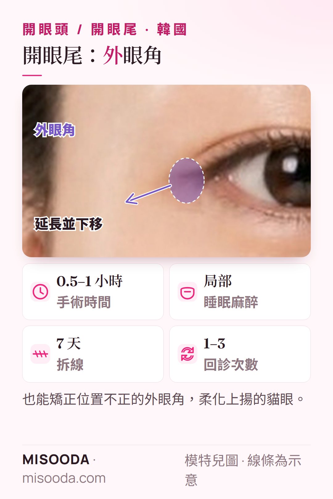 韓國 開眼尾:延長並下移外眼角,柔化上揚的貓眼;手術 0.5–1 小時,第 7 天拆線