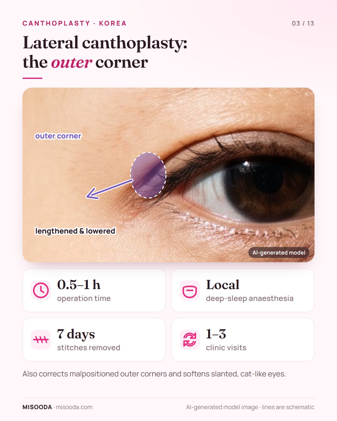 Lateral canthoplasty in Korea: the outer eye corner is lengthened and lowered to soften slanted, cat-like eyes; 0.5–1 hour, stitches out at 7 days