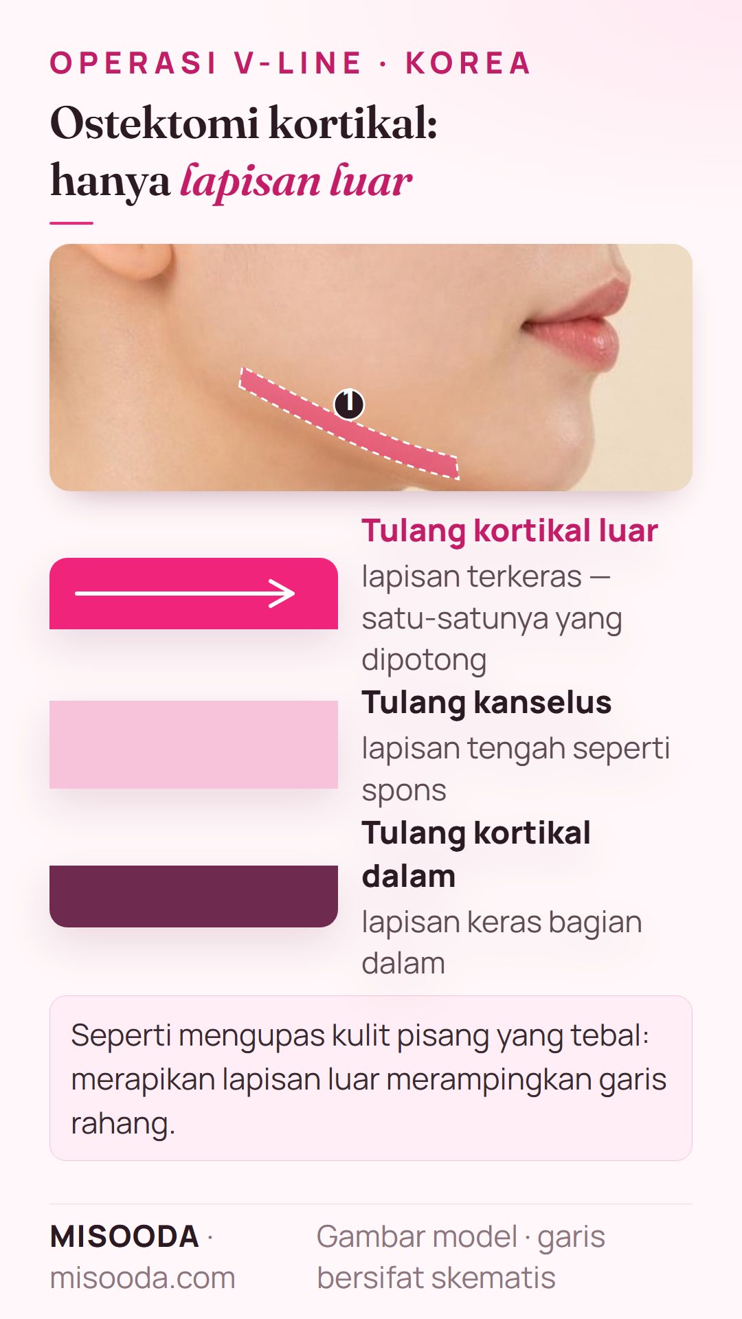 Ostektomi kortikal untuk garis rahang ramping: lapisan tulang rahang kortikal luar, kanselus, dan kortikal dalam, hanya lapisan kortikal luar yang dirapikan