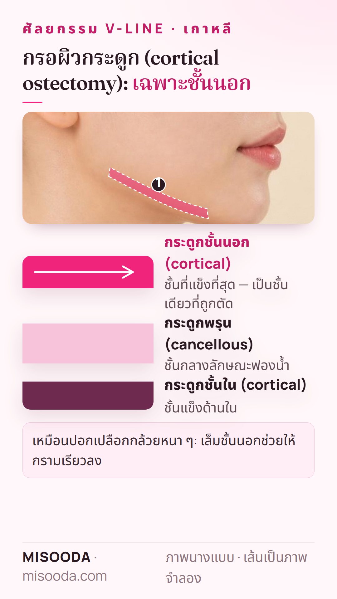 กรอผิวกระดูกเพื่อกรามเรียว: ชั้นกระดูกกรามได้แก่ชั้นนอก กระดูกพรุน และชั้นใน โดยเล็มเฉพาะชั้นนอก