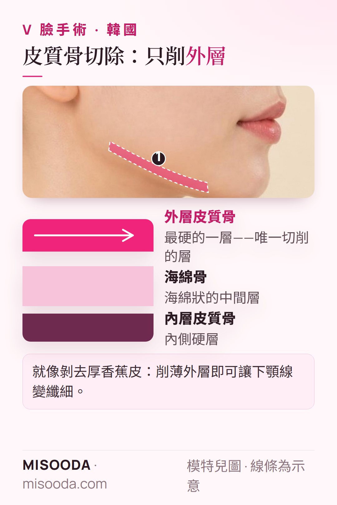 韓國 V 臉 皮質骨切除打造纖細下顎線:下顎骨分為外層皮質骨、海綿骨與內層皮質骨,只削外層皮質骨