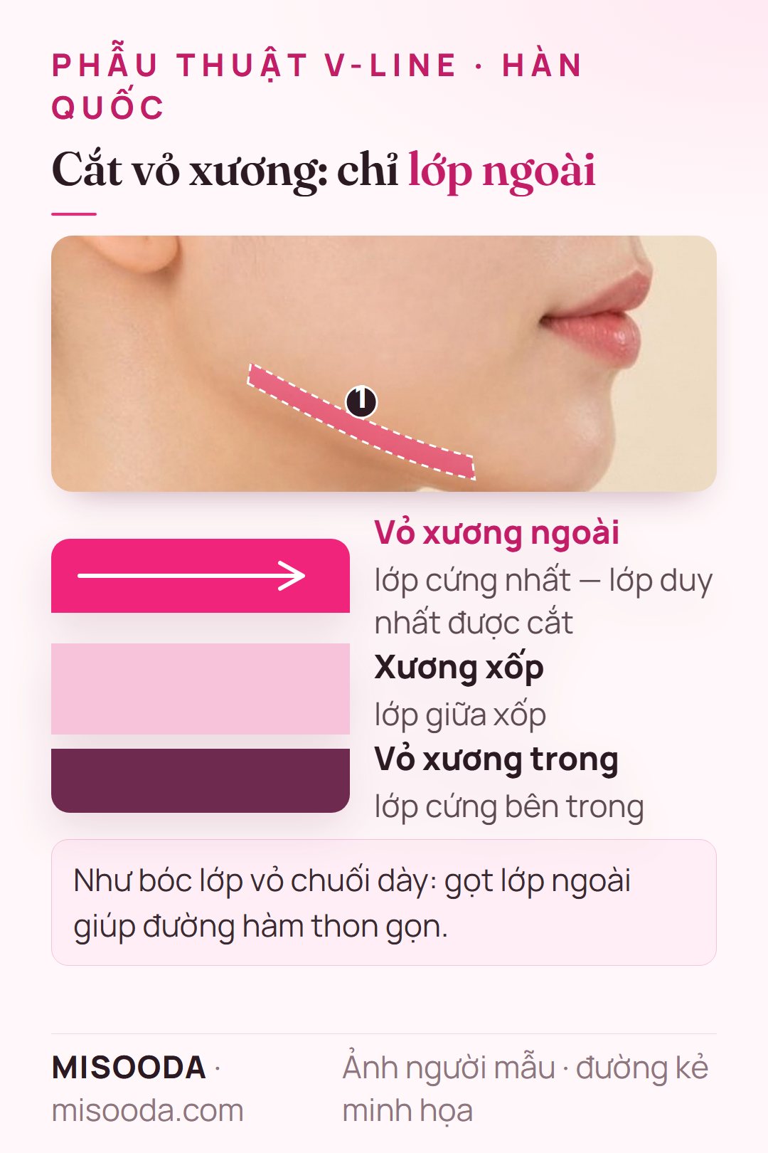 Cắt vỏ xương cho đường hàm thon: các lớp xương hàm gồm vỏ ngoài, xương xốp và vỏ trong, chỉ gọt lớp vỏ xương ngoài