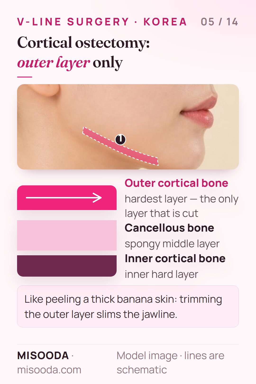 Cortical ostectomy for a slim jawline: jaw bone layers of outer cortical, cancellous and inner cortical bone, with only the outer cortical layer trimmed