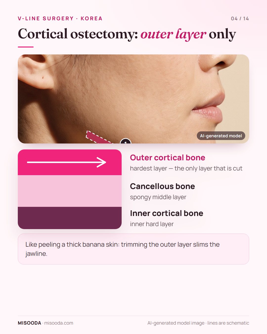 Cortical ostectomy for a slim jawline: jaw bone layers of outer cortical, cancellous and inner cortical bone, with only the outer cortical layer trimmed