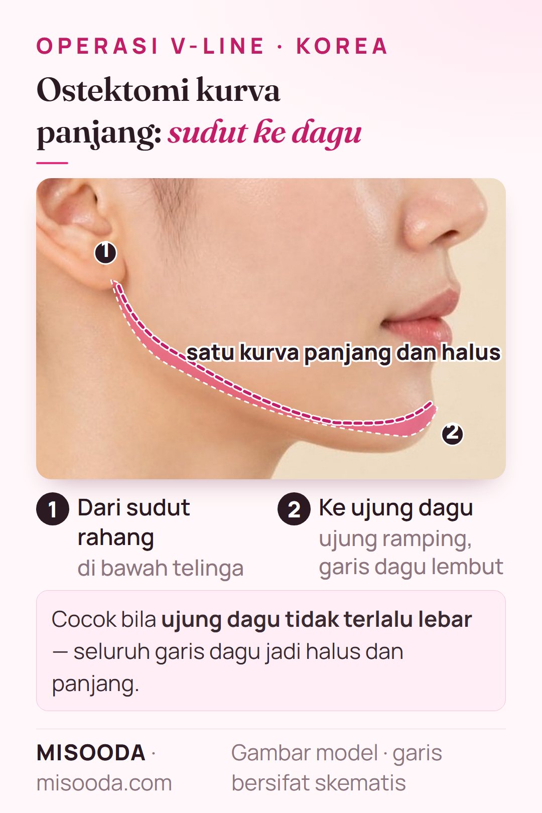 Ostektomi mandibula kurva panjang untuk V-line: satu kurva halus dari sudut rahang di bawah telinga hingga ujung dagu, ditampilkan pada profil samping