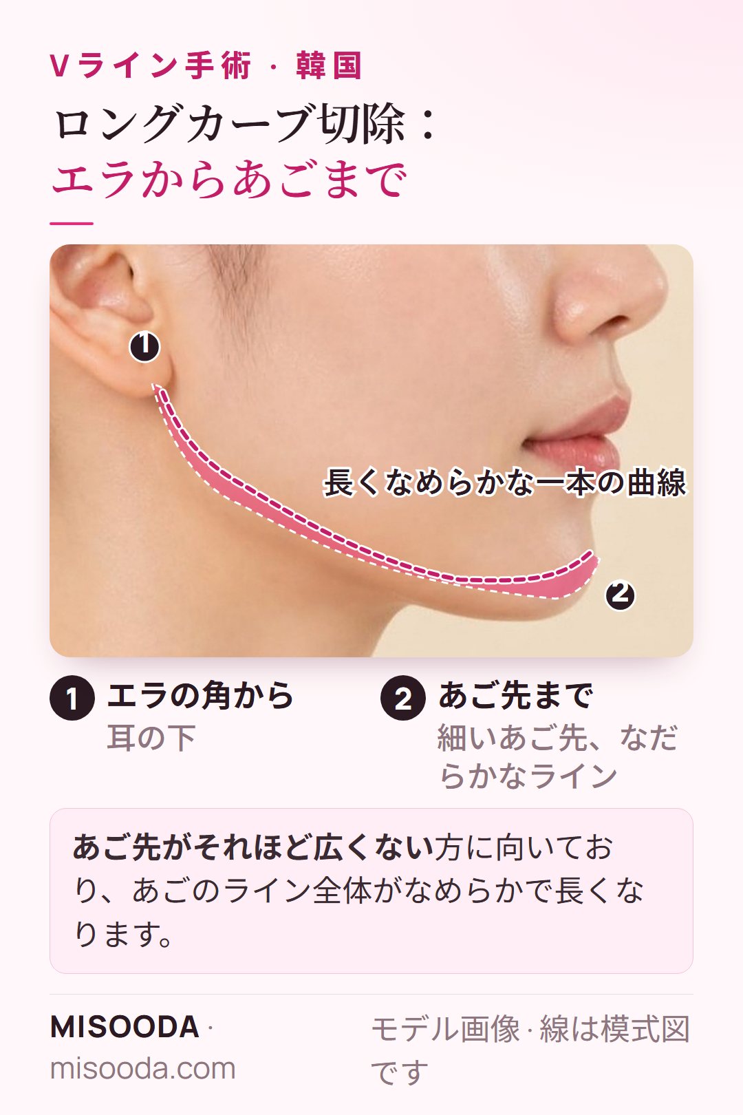 Vラインのロングカーブ切除:耳の下のエラの角からあご先まで一本のなめらかな曲線で削る、横顔の図