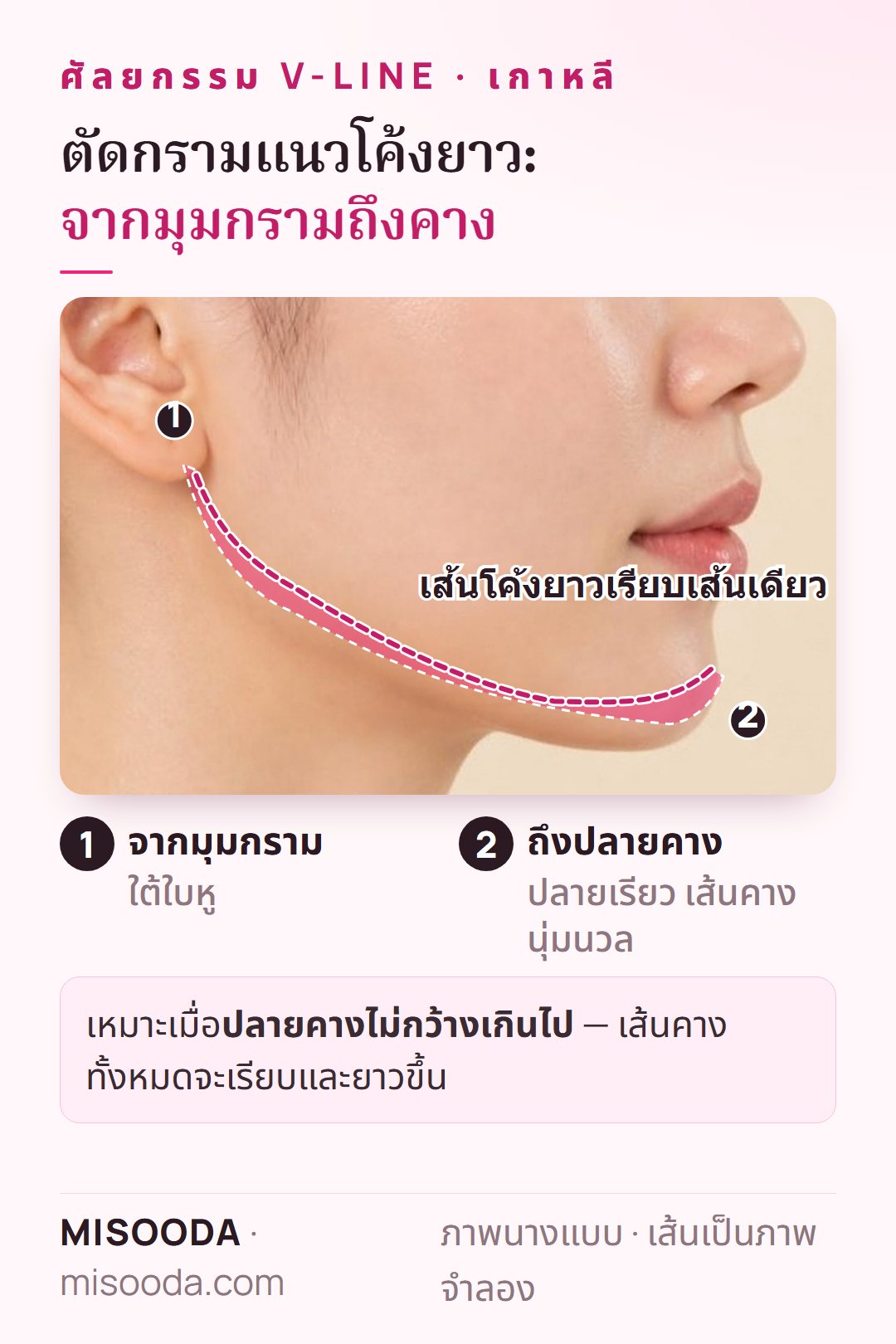 ตัดกรามแนวโค้งยาวสำหรับ V-line: เล็มเป็นเส้นโค้งเรียบเส้นเดียวจากมุมกรามใต้ใบหูถึงปลายคาง แสดงบนภาพด้านข้าง