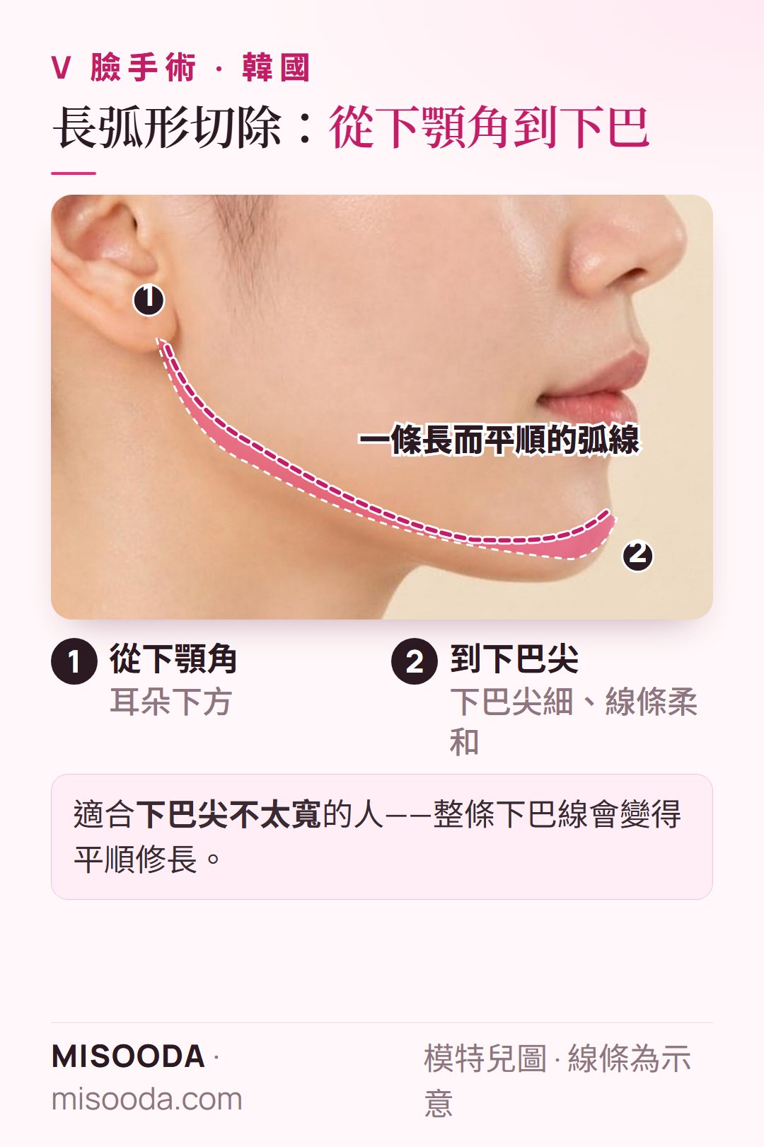 韓國 V 臉 長弧形下顎切除側面圖:從耳朵下方的下顎角一路到下巴尖,修成一條平順修長的弧線