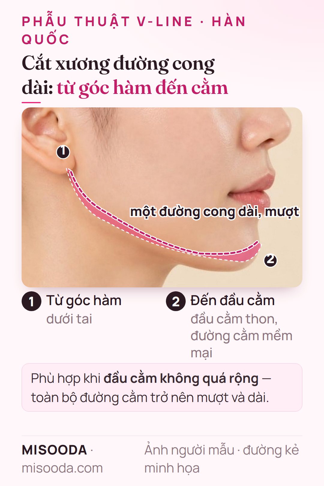 Cắt xương hàm đường cong dài cho V-line: gọt một đường cong mượt từ góc hàm dưới tai đến đầu cằm, minh họa trên dáng nghiêng