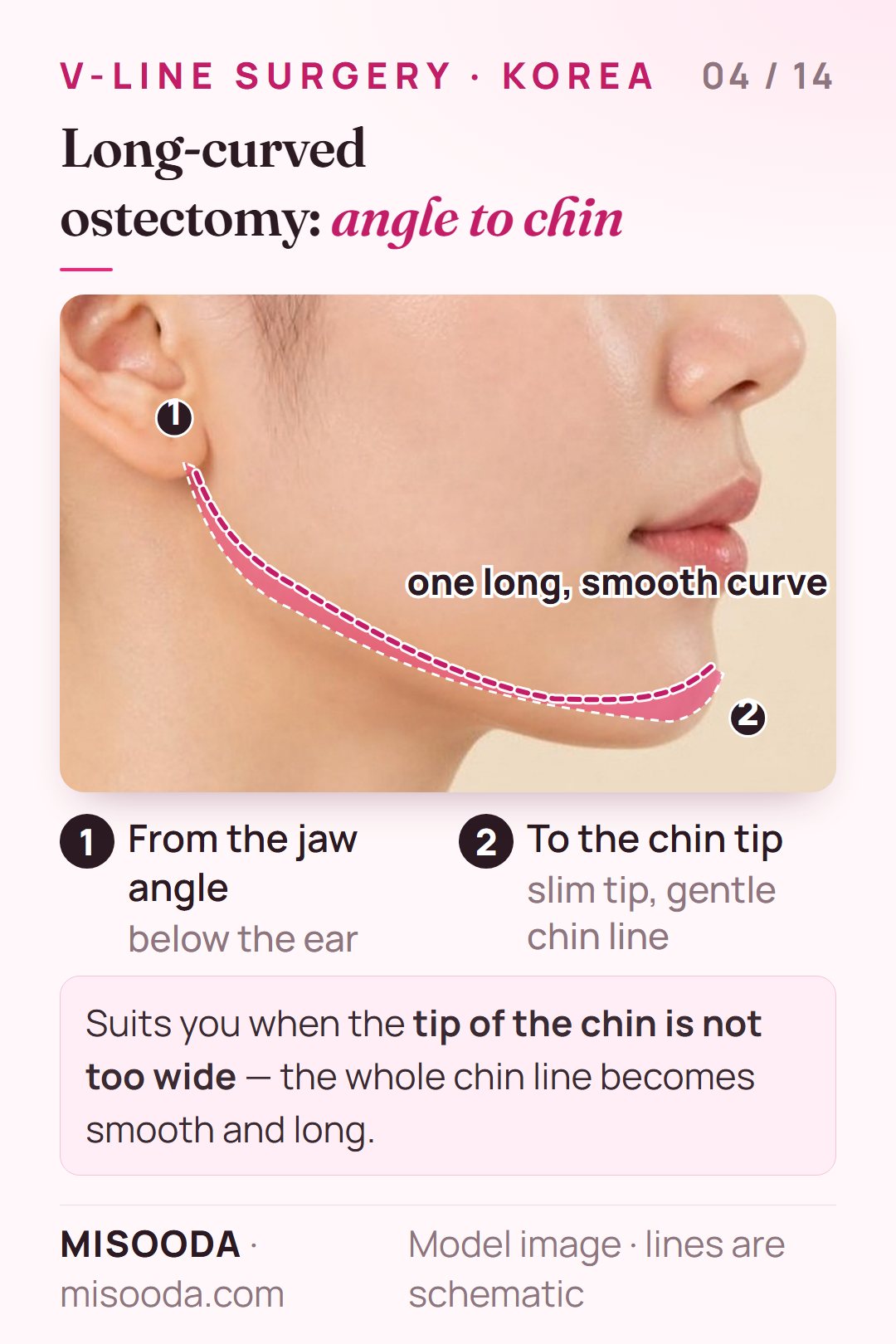 Long-curved mandibular ostectomy for V-line: one smooth curve trimmed from the jaw angle below the ear to the tip of the chin, shown on a side profile