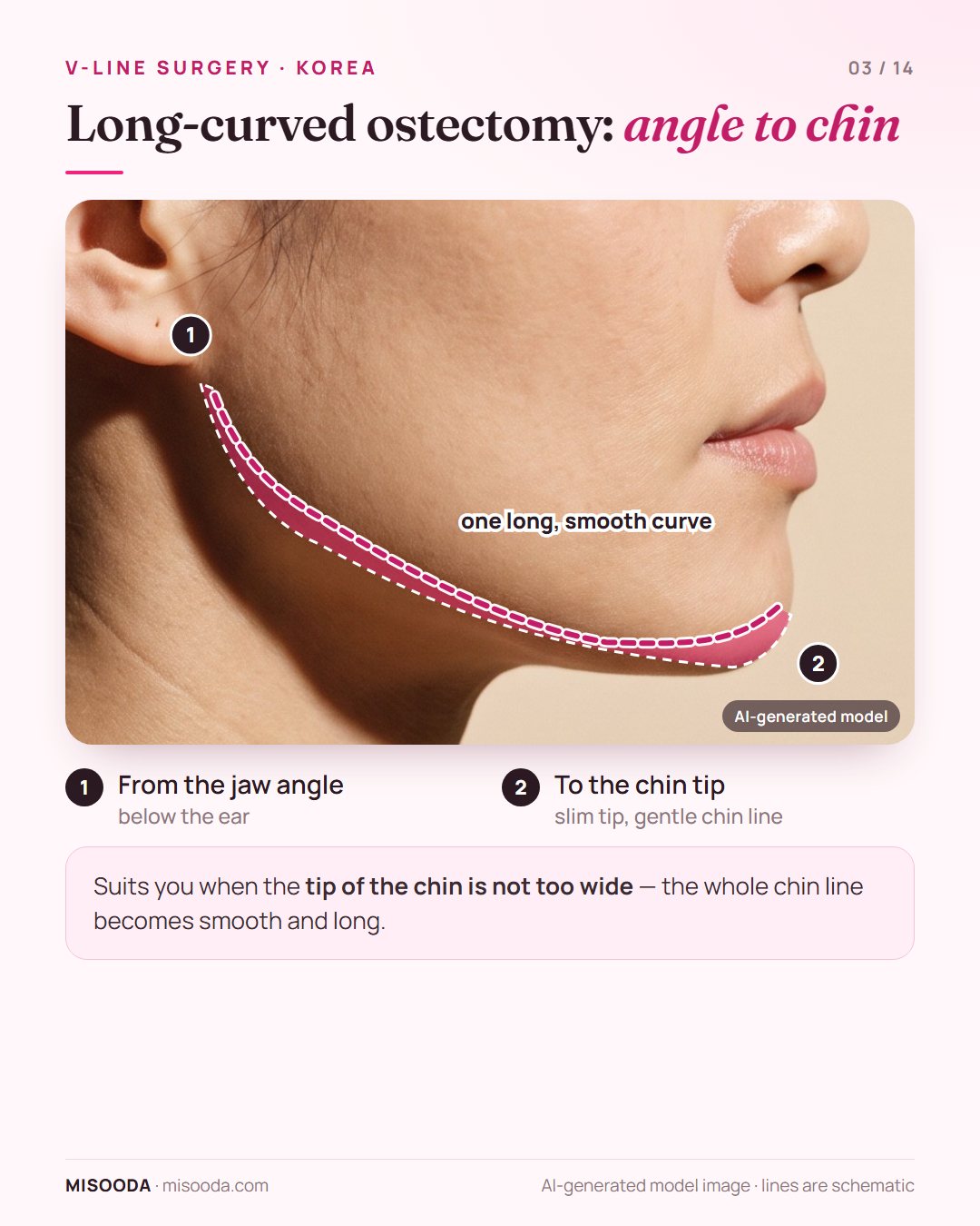 Long-curved mandibular ostectomy for V-line: one smooth curve trimmed from the jaw angle below the ear to the tip of the chin, shown on a side profile