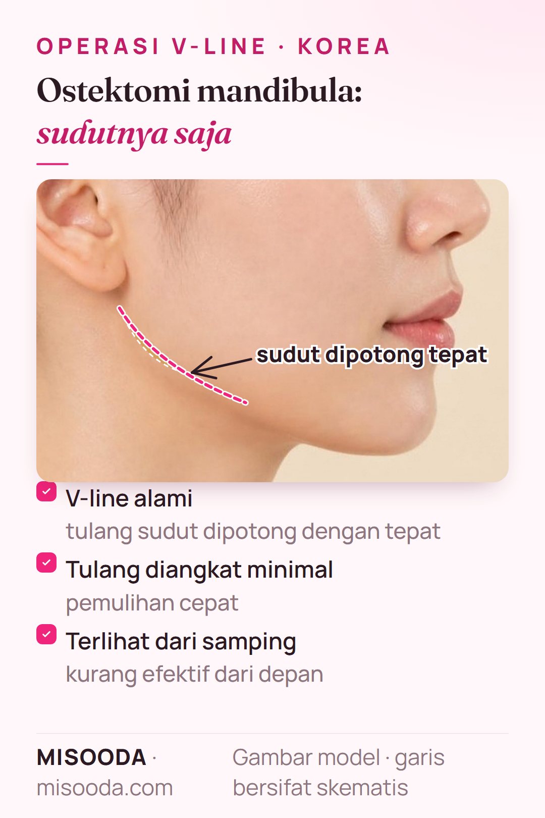 Ostektomi mandibula untuk V-line di Korea: tulang sudut rahang dipotong tepat, tulang diangkat minimal dan pemulihan cepat, paling terlihat dari profil samping