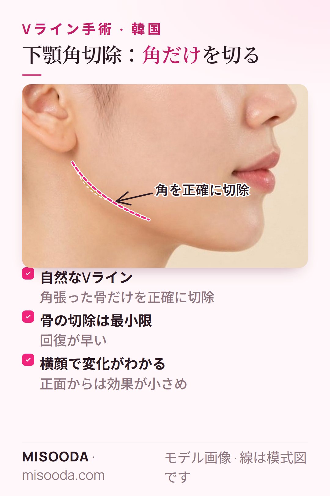 Vラインの下顎角切除:角張ったエラの骨だけを正確に切除し、骨の切除は最小限で回復が早く、主に横顔で効果が見えます