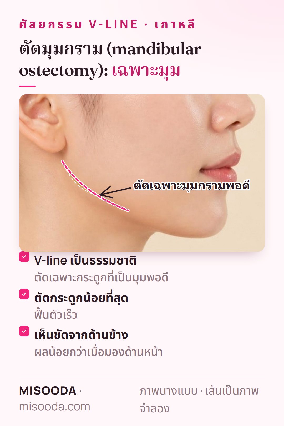 ตัดมุมกรามสำหรับ V-line: ตัดเฉพาะกระดูกกรามที่เป็นมุมพอดี ตัดกระดูกน้อยและฟื้นตัวเร็ว เห็นชัดที่สุดจากด้านข้าง