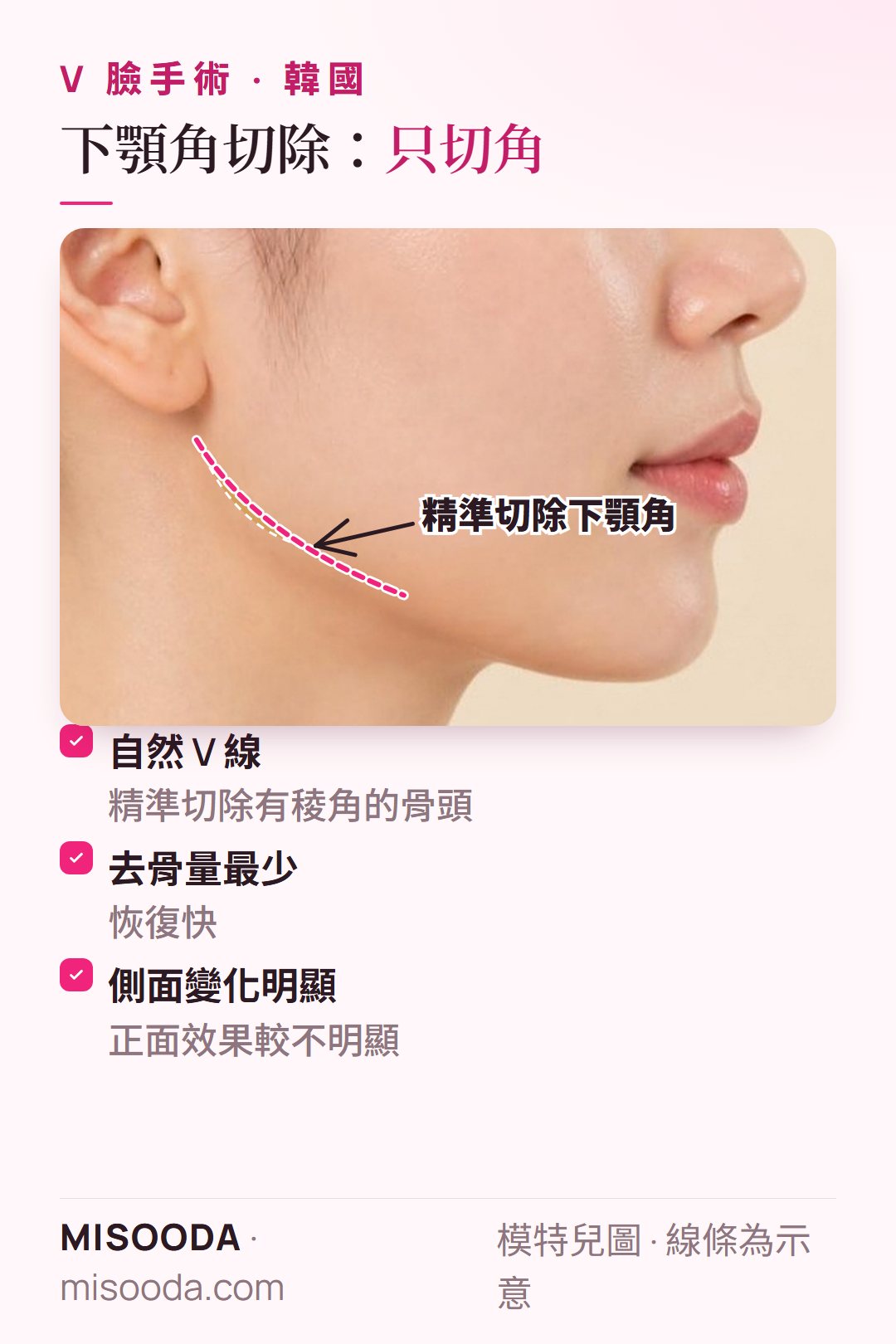 韓國 V 臉 下顎角切除:精準切除有稜角的下顎骨,去骨最少、恢復快,側面變化最明顯