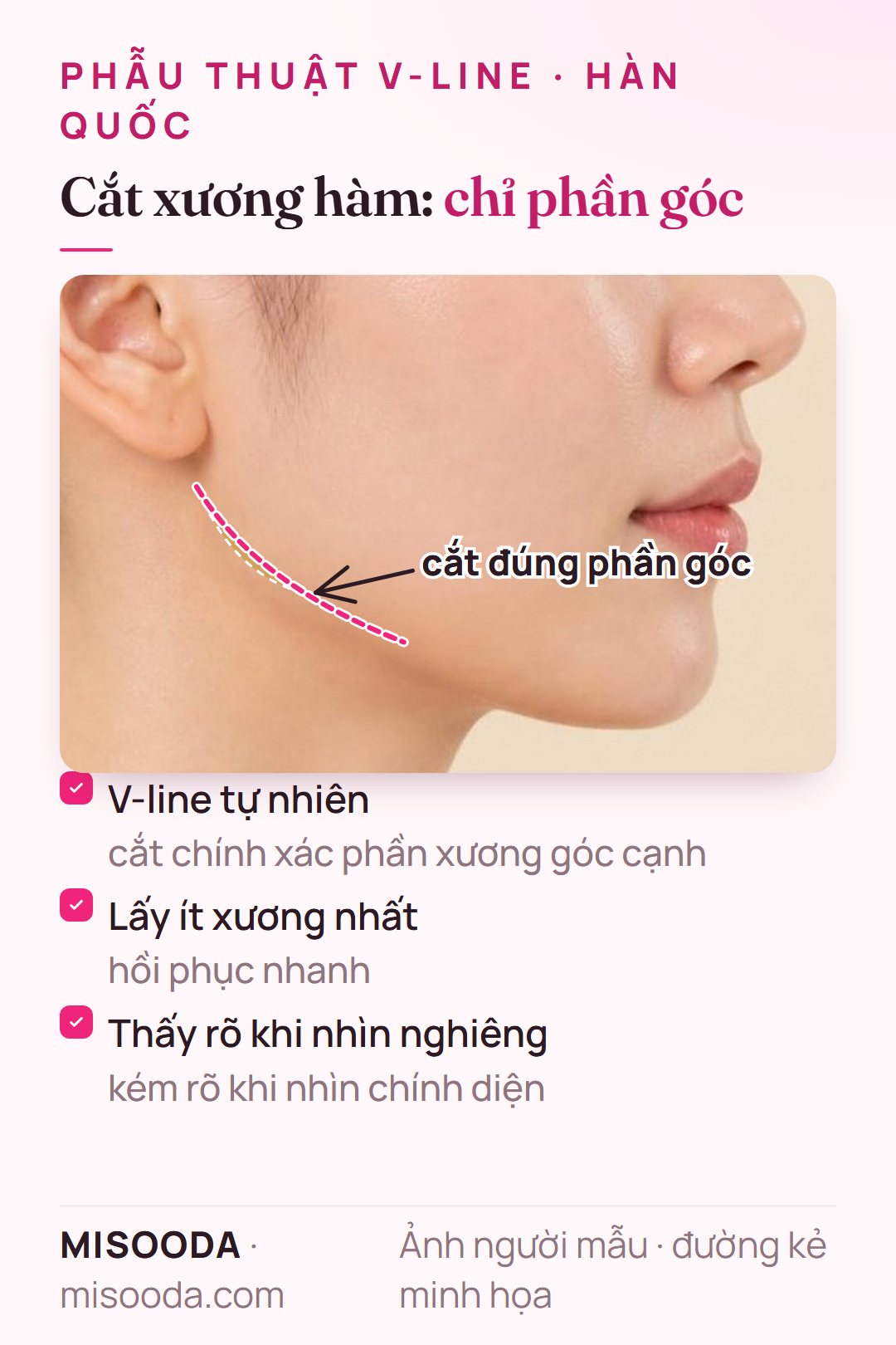 Cắt xương hàm cho V-line: cắt chính xác phần xương góc cạnh, lấy ít xương, hồi phục nhanh, thấy rõ nhất khi nhìn nghiêng