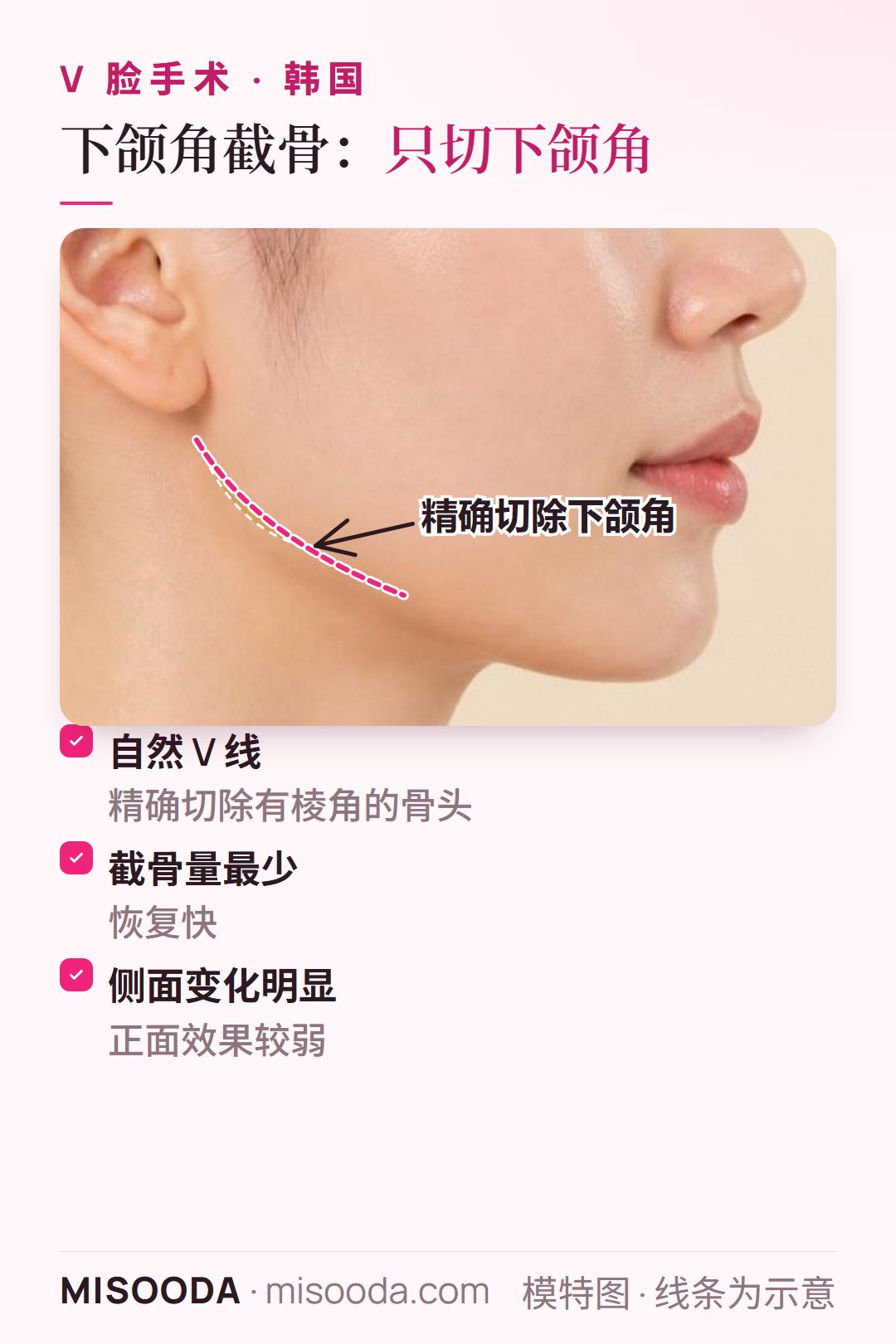 韩国 V 脸下颌角截骨:精确切除有棱角的下颌骨,截骨量最少、恢复快,从侧面看变化最明显