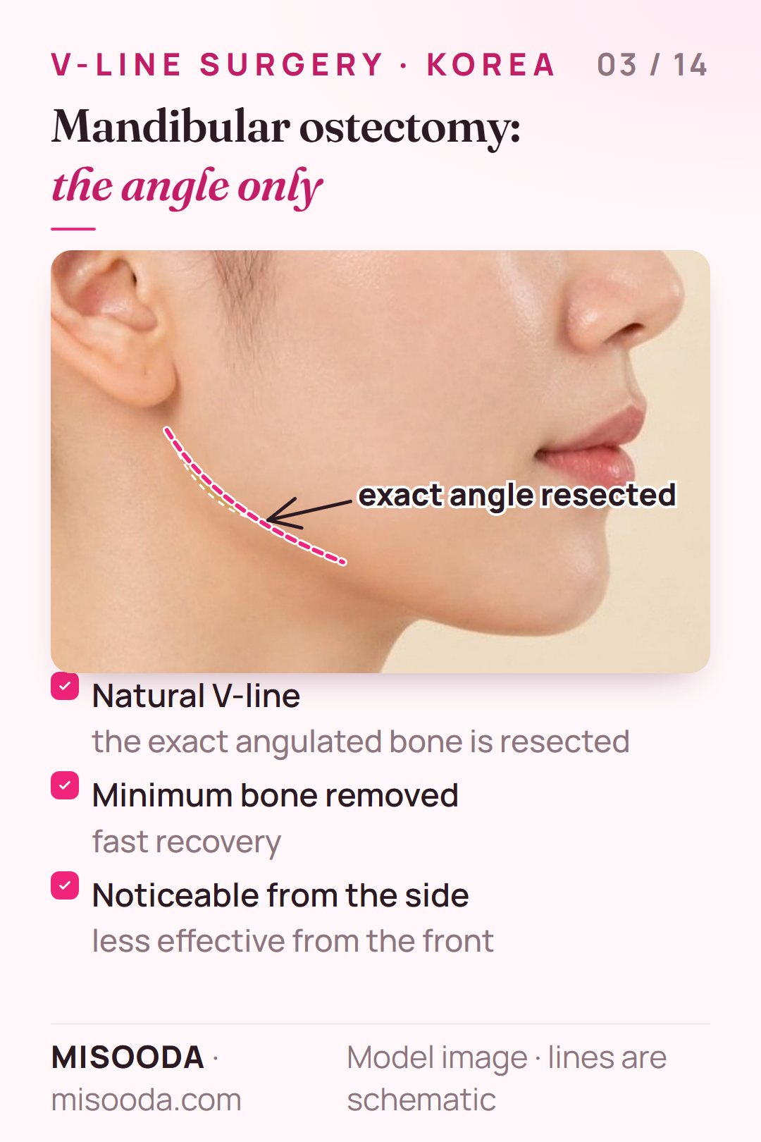 Mandibular ostectomy for V-line: the exact angulated jaw bone is resected, with minimal bone removed and fast recovery, most visible from the side profile