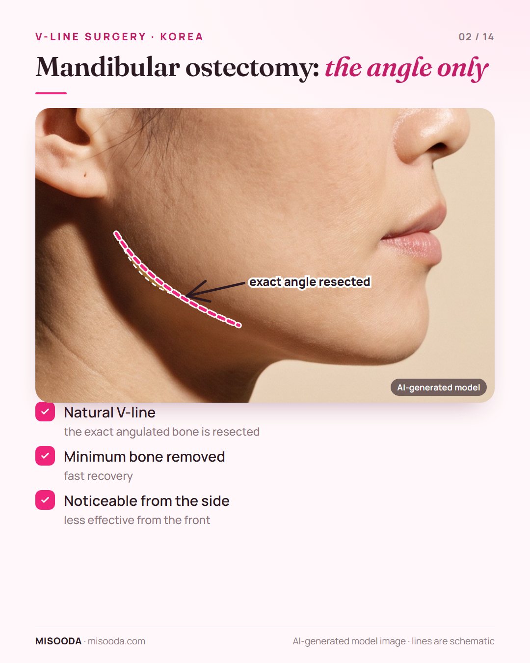 Mandibular ostectomy for V-line: the exact angulated jaw bone is resected, with minimal bone removed and fast recovery, most visible from the side profile