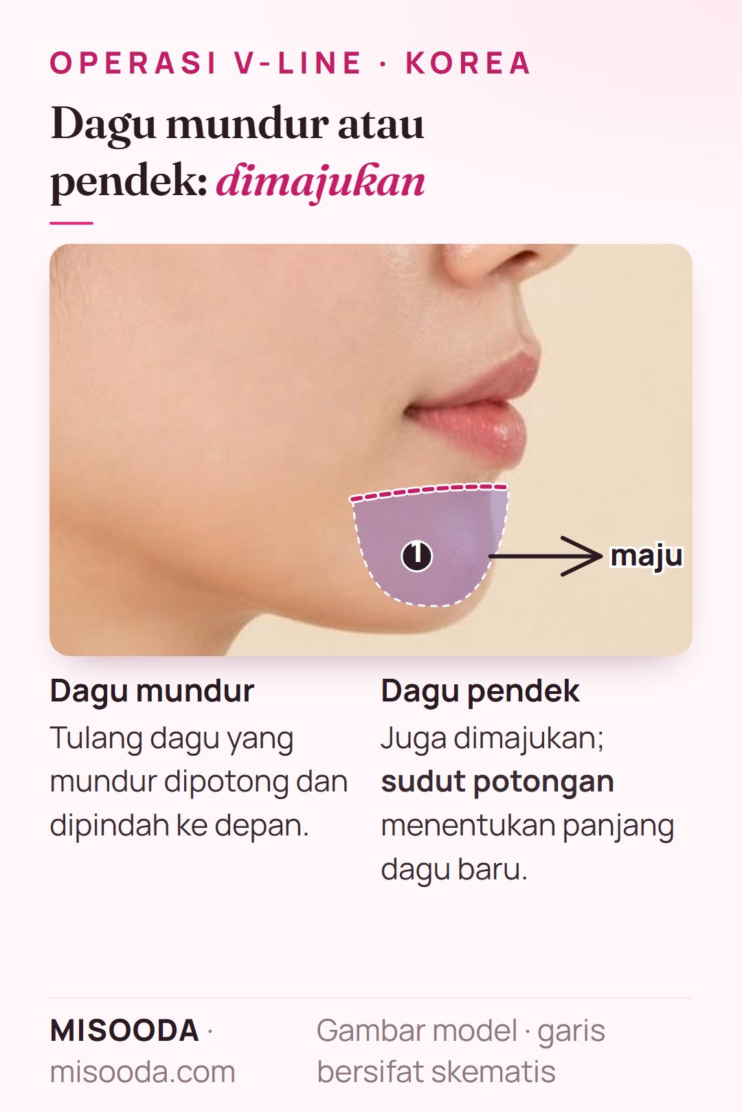 Koreksi dagu mundur dan dagu pendek di Korea: tulang dagu dipotong dan dimajukan, sudut potongan mengatur panjang dagu, pada profil samping