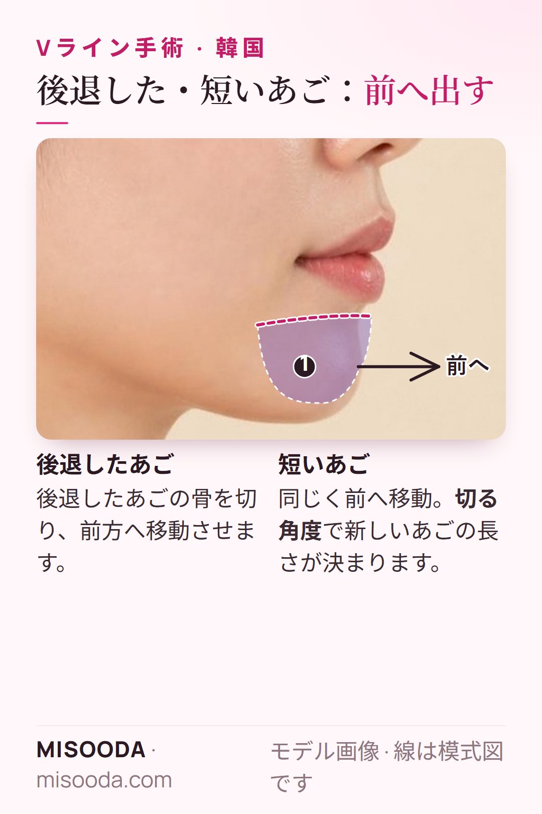 韓国 後退したあご・短いあごの矯正:あごの骨を切って前へ移動し、切る角度であごの長さを調整する横顔の図