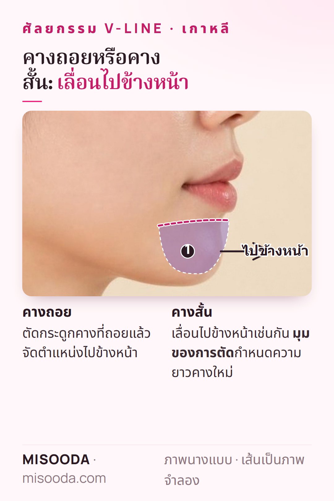 แก้คางถอยและคางสั้นในเกาหลี: ตัดกระดูกคางแล้วเลื่อนไปข้างหน้า มุมของการตัดปรับความยาวคาง แสดงบนภาพด้านข้าง