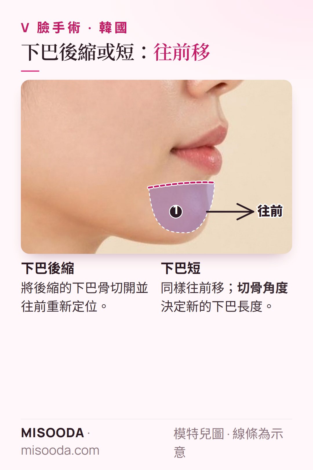 韓國 V 臉 下巴後縮與短下巴矯正側面圖:將下巴骨切開後往前移動,並以切骨角度調整新的下巴長度