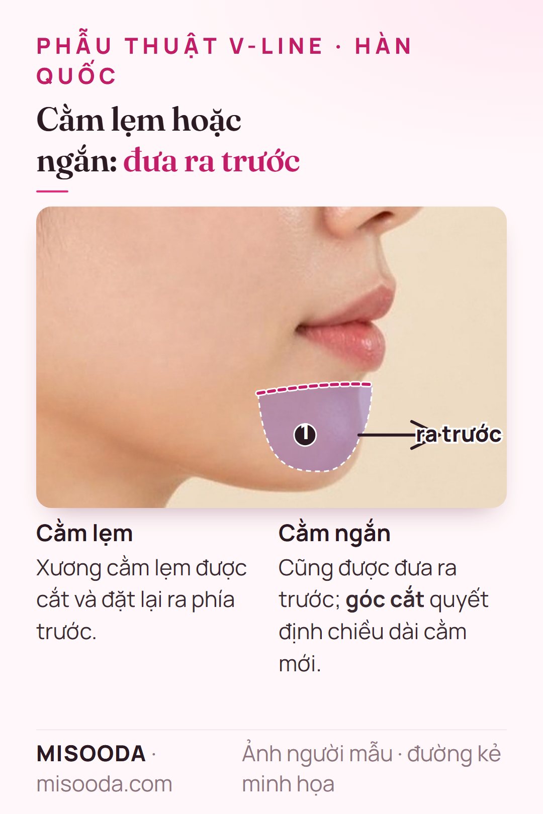 Chỉnh cằm lẹm và cằm ngắn tại Hàn Quốc: xương cằm được cắt và đưa ra trước, góc cắt điều chỉnh chiều dài cằm, trên dáng nghiêng