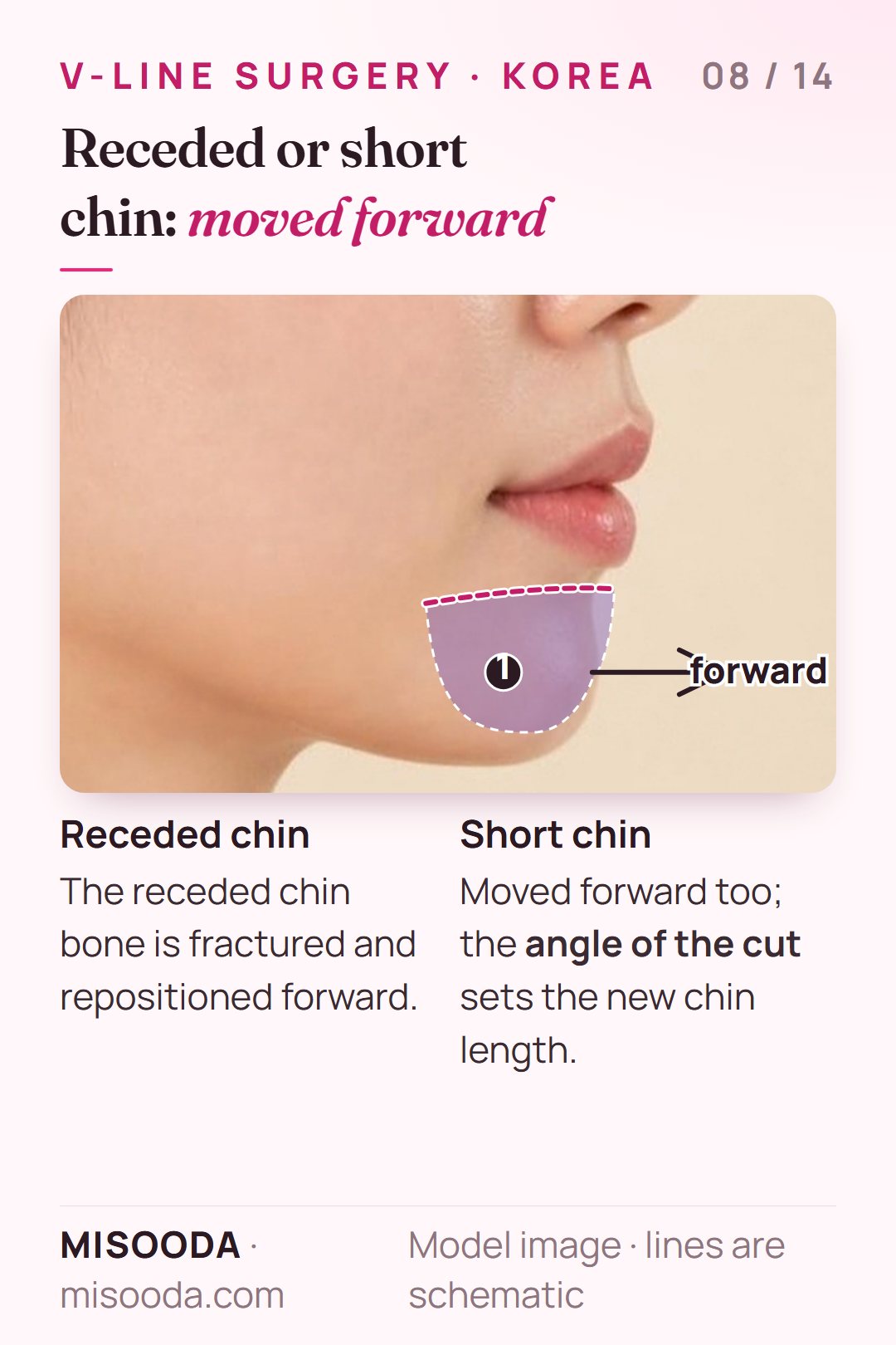 Receded chin and short chin correction in Korea: the chin bone is fractured and moved forward, the cut angle adjusting chin length, on a side profile
