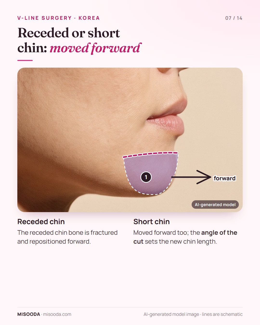 Receded chin and short chin correction in Korea: the chin bone is fractured and moved forward, the cut angle adjusting chin length, on a side profile