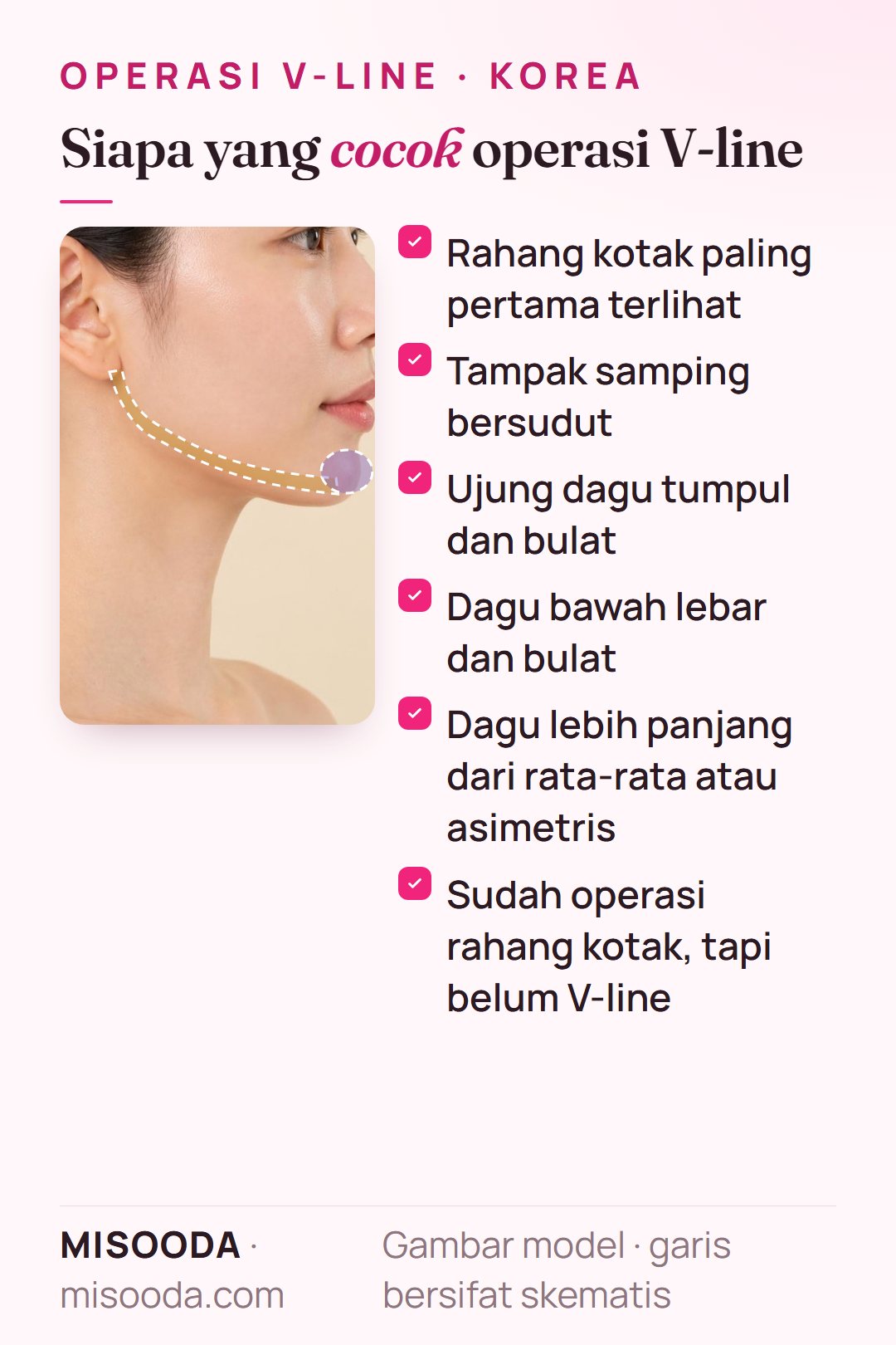 Kandidat operasi V-line di Korea: rahang kotak paling menonjol, tampak samping bersudut, dagu tumpul, lebar, panjang atau asimetris, atau belum V-line setelah operasi rahang