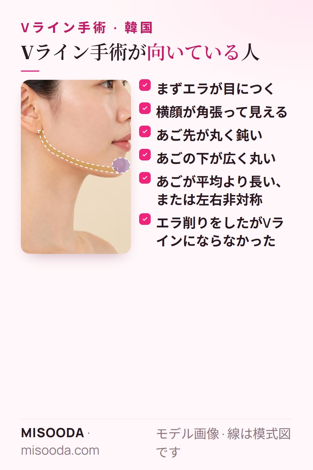 Vライン手術が向いている人:まずエラが目につく、横顔が角張る、あご先が鈍い・広い・長い・非対称、エラ削り後もVラインでない