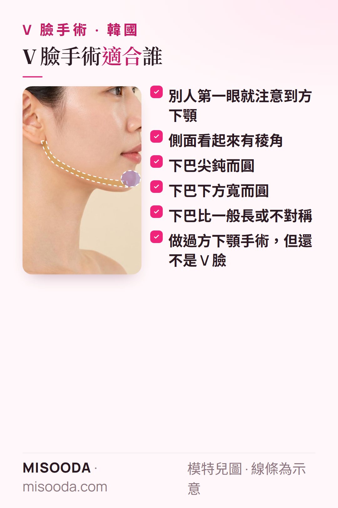 韓國 V 臉手術適合對象:方下顎最先引人注意、側面有稜角、下巴鈍寬長或不對稱,或做過下顎手術仍非 V 臉