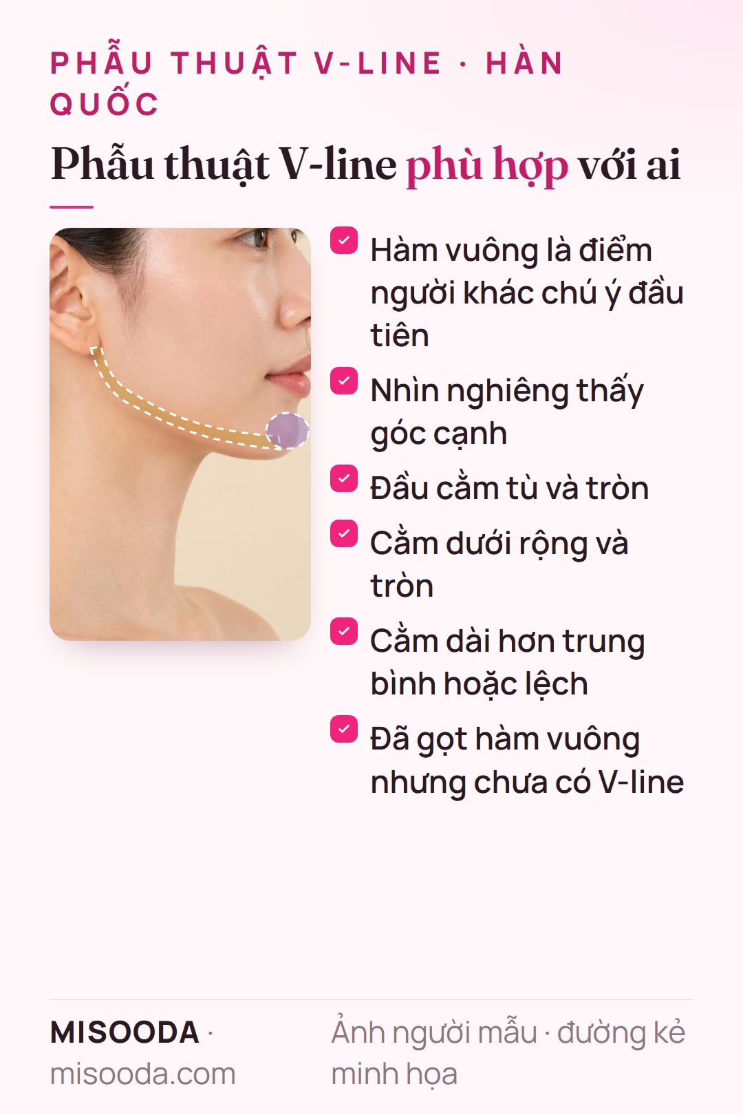 Đối tượng phẫu thuật V-line: hàm vuông là điểm dễ thấy nhất, nhìn nghiêng góc cạnh, cằm tù, rộng, dài hoặc lệch, hoặc chưa có V-line sau gọt hàm