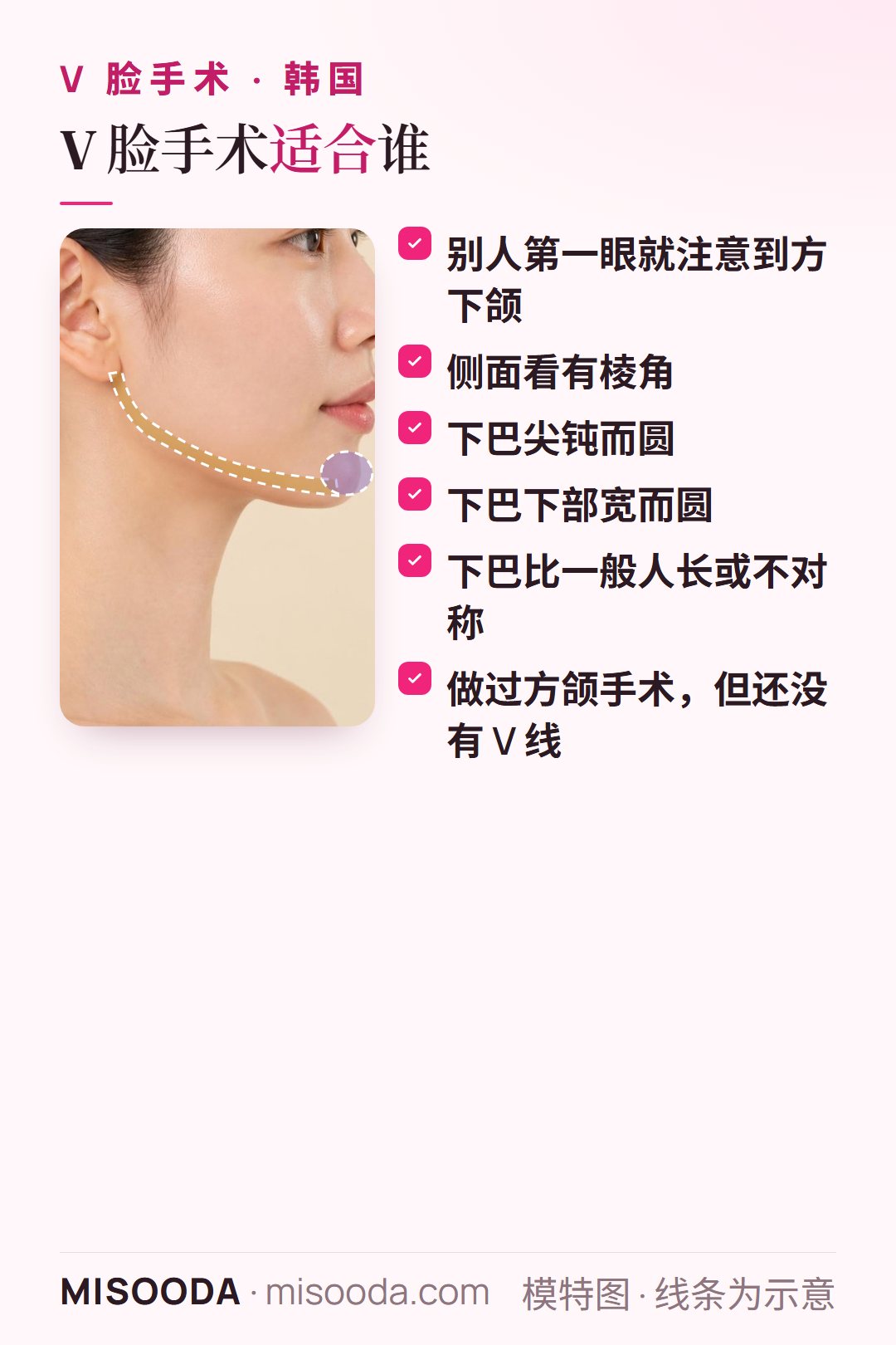 韩国 V 脸手术适合人群:第一眼就注意到方下颌、侧面有棱角、下巴钝、宽、长或不对称,或下颌手术后仍无 V 线