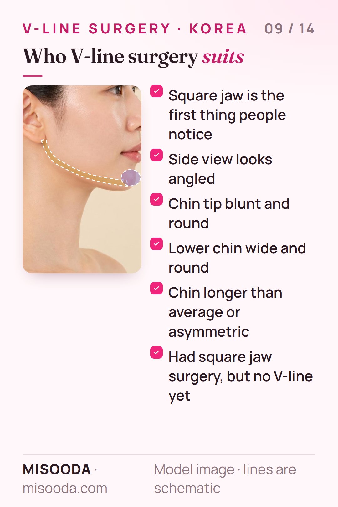 Candidates for V-line surgery: square jaw as the first noticeable feature, angled side view, blunt, wide, long or asymmetric chin, or no V-line after jaw surgery