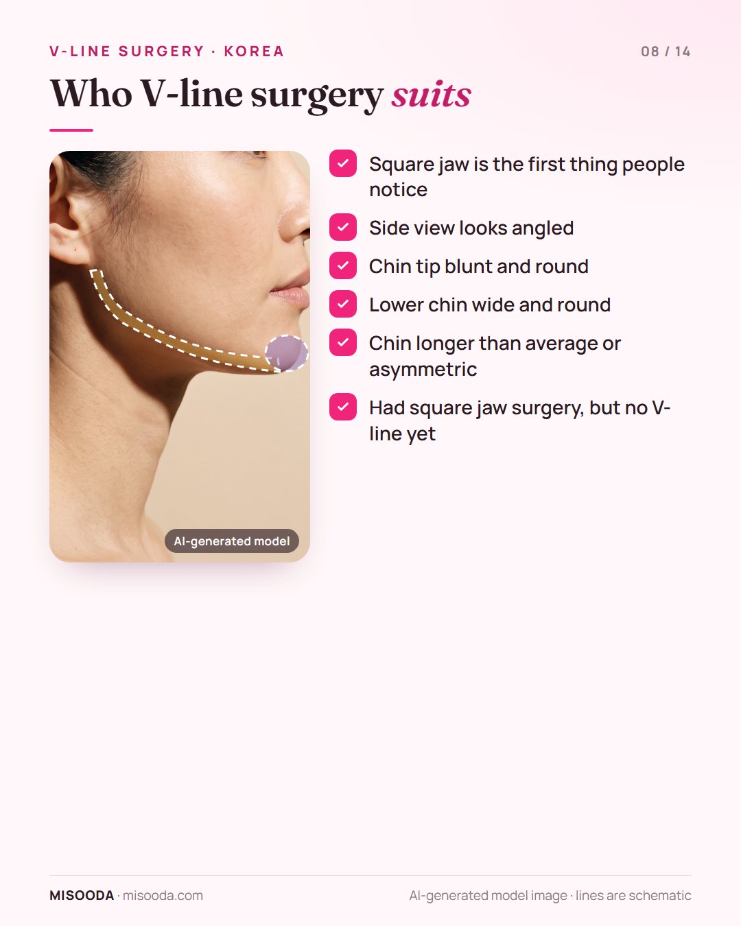 Candidates for V-line surgery: square jaw as the first noticeable feature, angled side view, blunt, wide, long or asymmetric chin, or no V-line after jaw surgery