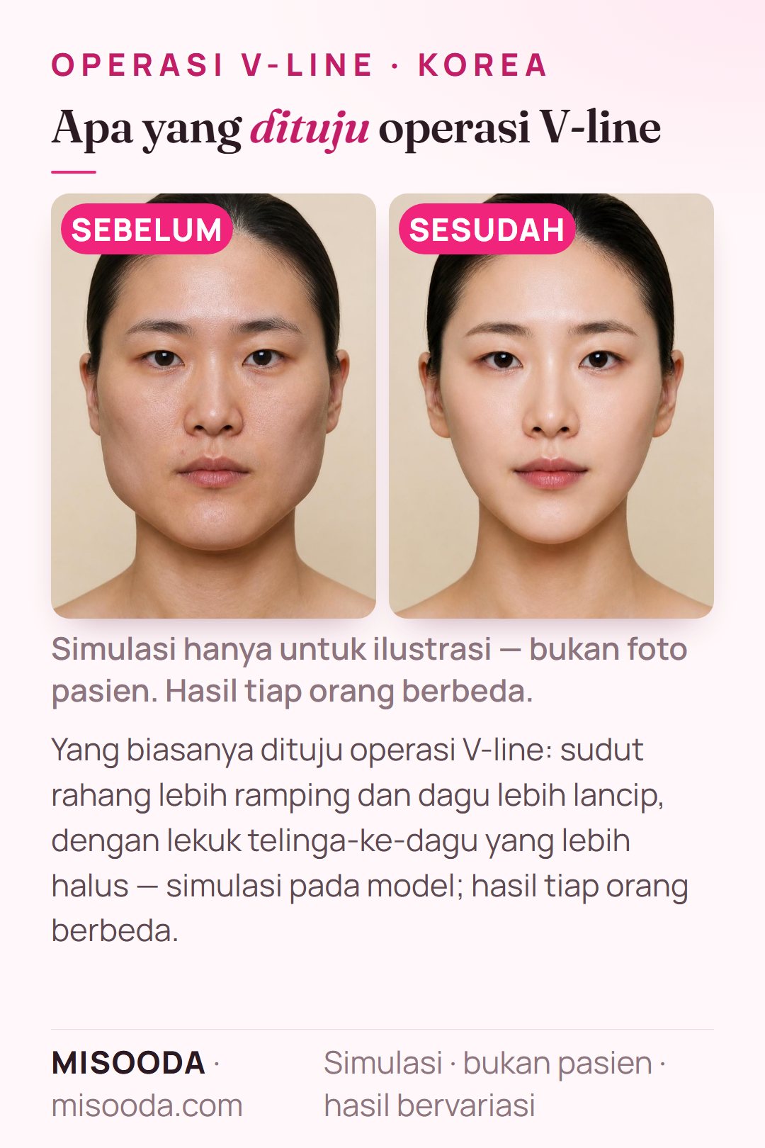 Ilustrasi tujuan umum operasi V-line (pengecilan rahang) di Korea — sudut rahang lebih ramping dan dagu lancip dengan lekuk telinga-ke-dagu lebih halus — disimulasikan pada model