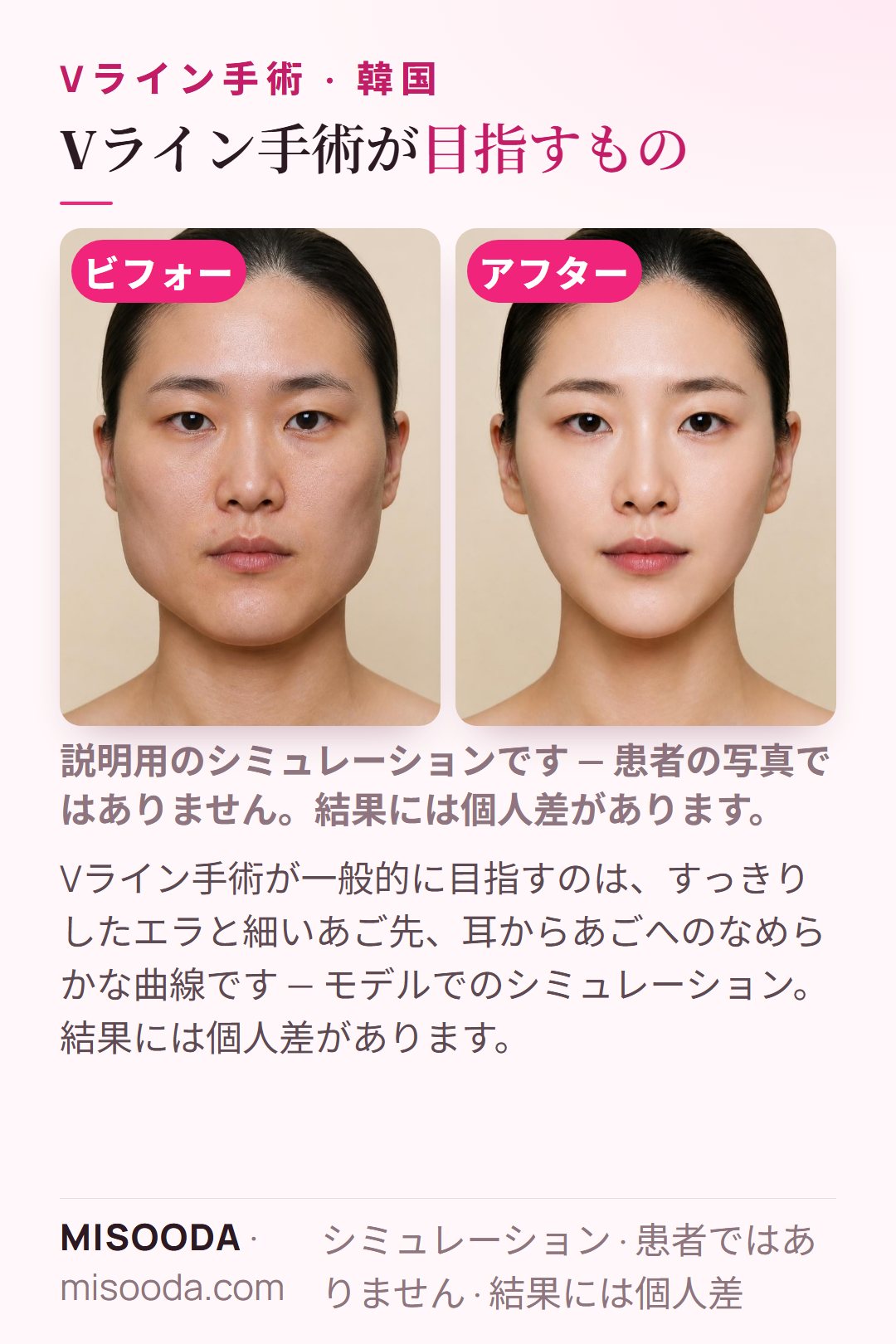 韓国のVライン手術(エラ削り)が一般的に目指す変化のイラスト — すっきりしたエラと細いあご先、耳からあごへのなめらかな曲線。モデルによるシミュレーションです