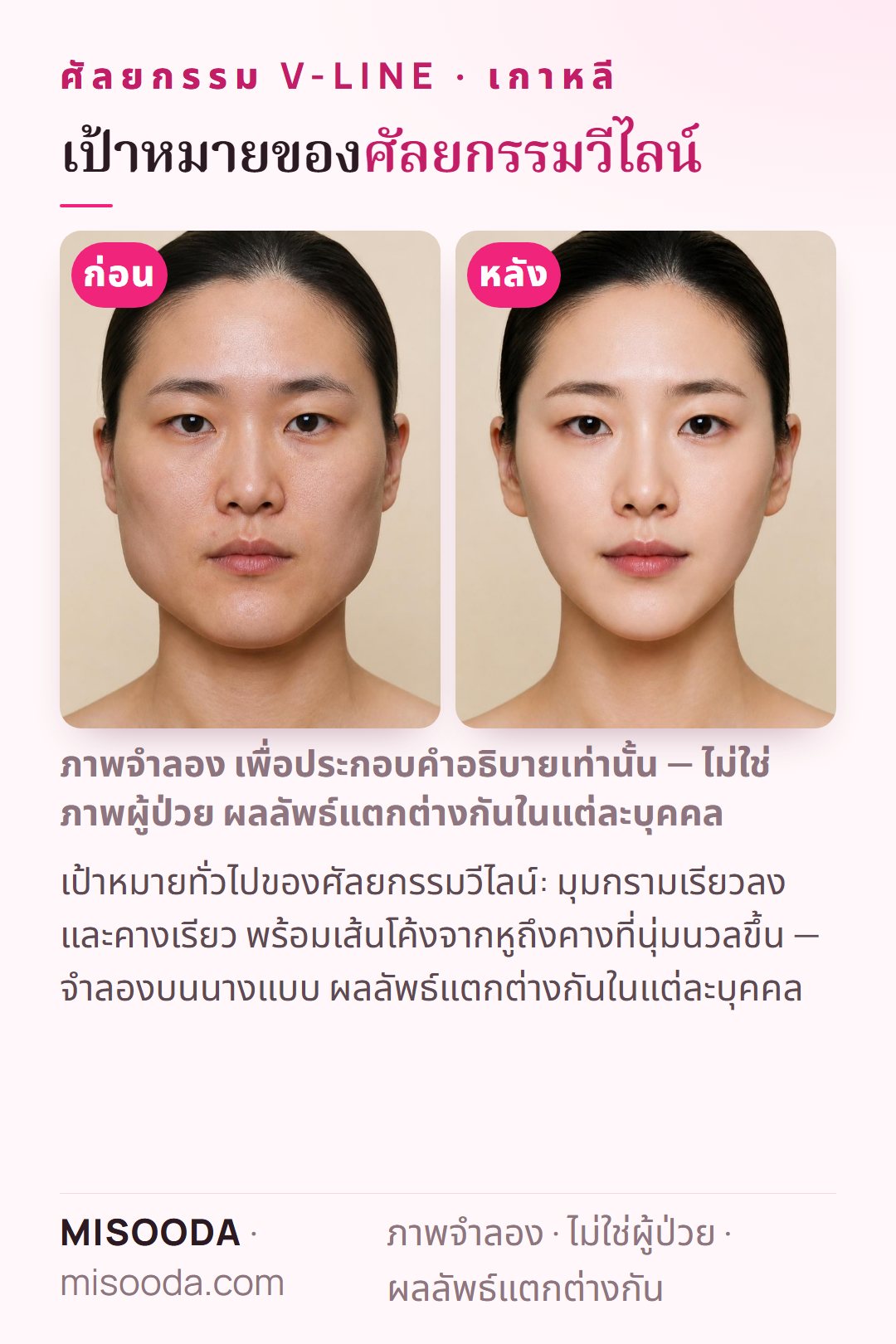 ภาพประกอบเป้าหมายทั่วไปของศัลยกรรมวีไลน์ (ตัดกราม) ที่เกาหลี — มุมกรามเรียวลงและคางเรียว พร้อมเส้นโค้งจากหูถึงคางที่นุ่มนวลขึ้น — จำลองบนนางแบบ