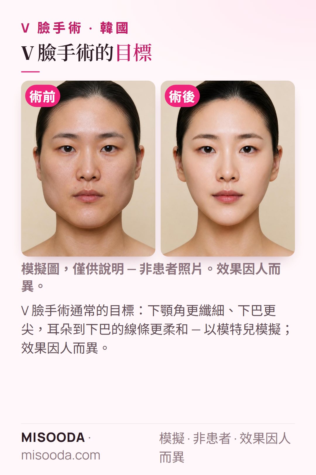韓國 V 臉手術(削骨、下顎角縮小)常見目標示意圖 — 下顎角更纖細、下巴更尖,耳朵到下巴的線條更柔和 — 以模特兒模擬呈現,效果因人而異