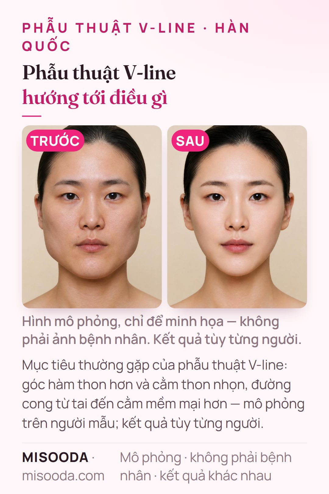 Minh họa mục tiêu thường gặp của phẫu thuật V-line (gọt hàm) tại Hàn Quốc — góc hàm thon hơn, cằm thon nhọn và đường cong từ tai đến cằm mềm mại hơn — mô phỏng trên người mẫu