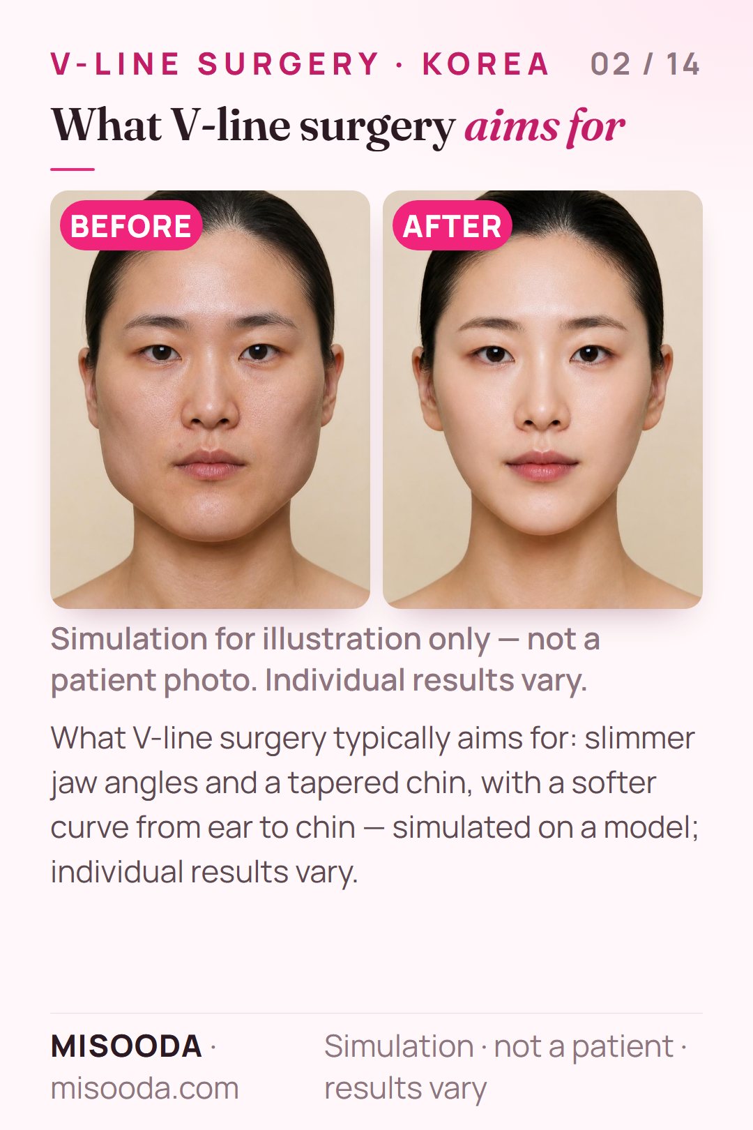 Illustration of the typical goals of V-line jaw reduction — slimmer jaw angles and a tapered chin with a softer ear-to-chin curve — simulated on a model