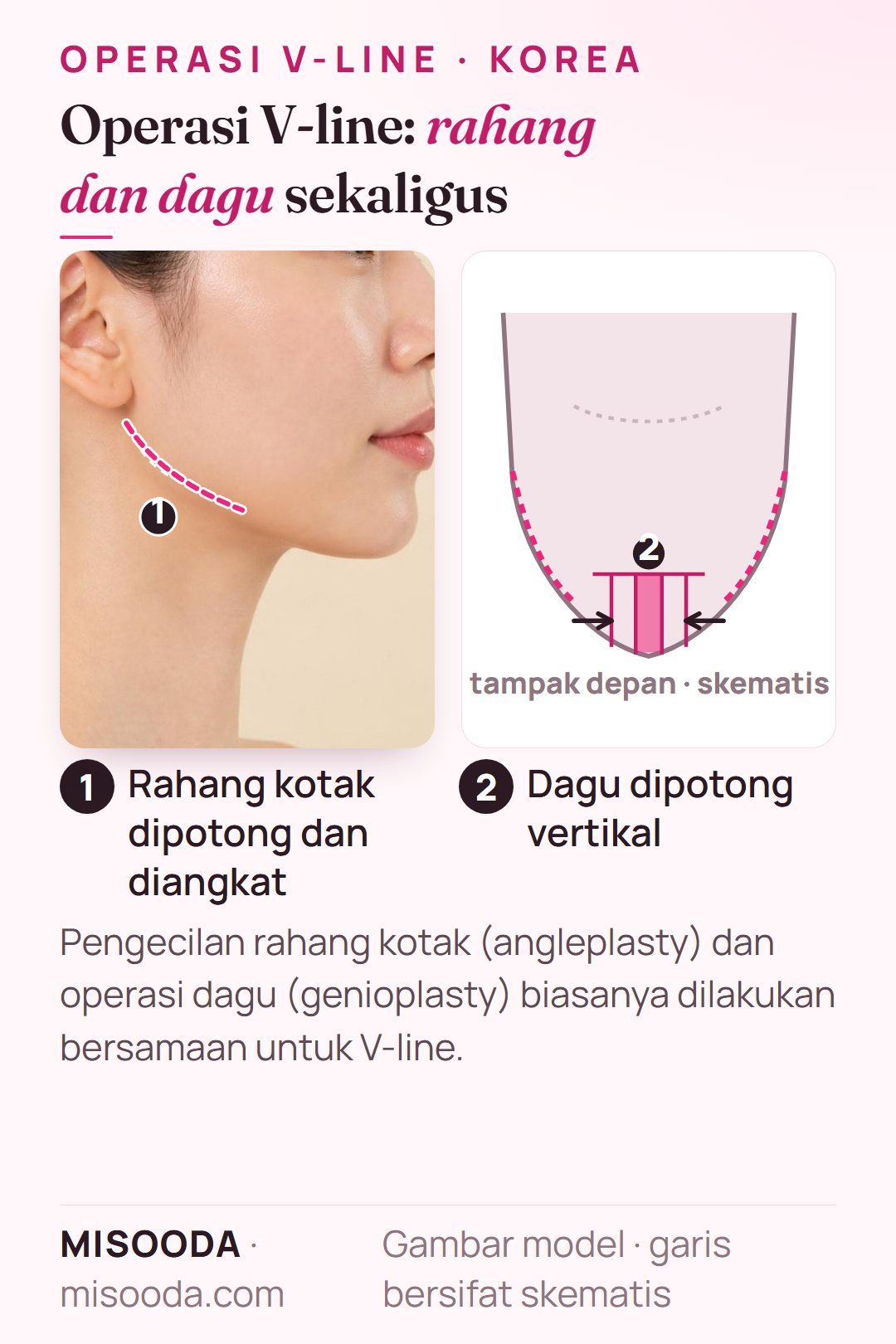 Operasi V-line di Korea: sudut rahang kotak dipotong dan diangkat di kedua sisi, dagu dipotong vertikal dengan tulang tengah diangkat dan didorong ke dalam, skematis